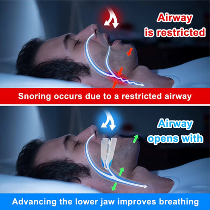 Teeth Bruxism Anti-Snoring Mouthpiece Device anti Snore Mouth Guard Improve Sleeping Snoring Aid Apnea Device Stop Snoring Guard